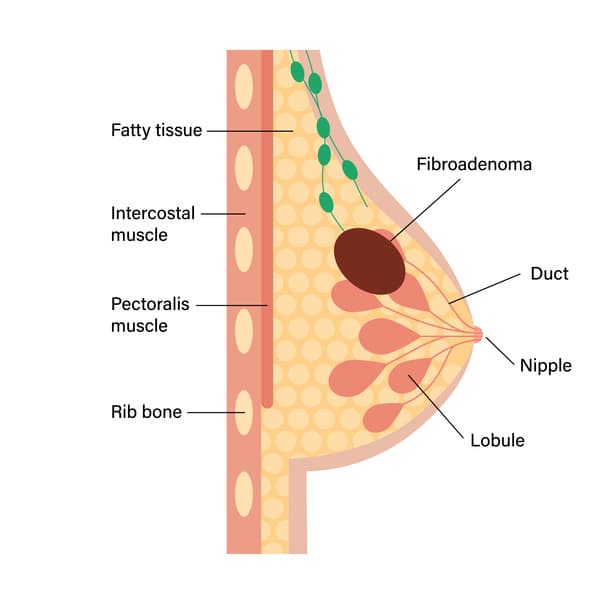 fibroadenoma